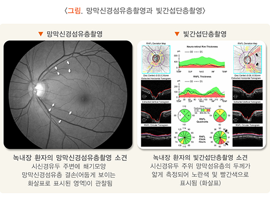 녹내장을 진단하는 검사법. /자료=국가건강정보포털