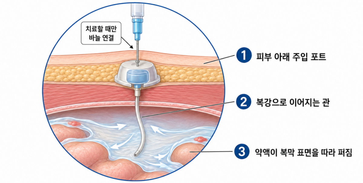 복강 내 파클리탁셀 주입 치료 개념도. /사진제공=분당서울대병원