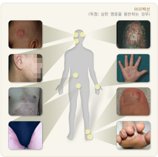 무좀은 발뿐 아니라 다양한 부위에서 생길 수 있다. /사진=국가건강정보포털
