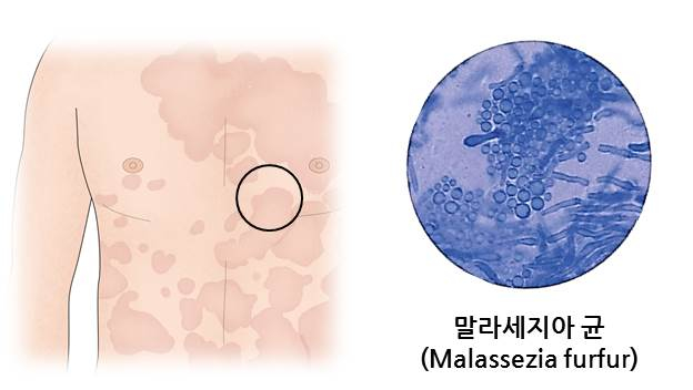 어루러기 병변으로 나타나는 반점(왼쪽), 어루러기를 일으키는 곰팡이인 말라세지아 균(오른쪽). /자료=서울아산병원