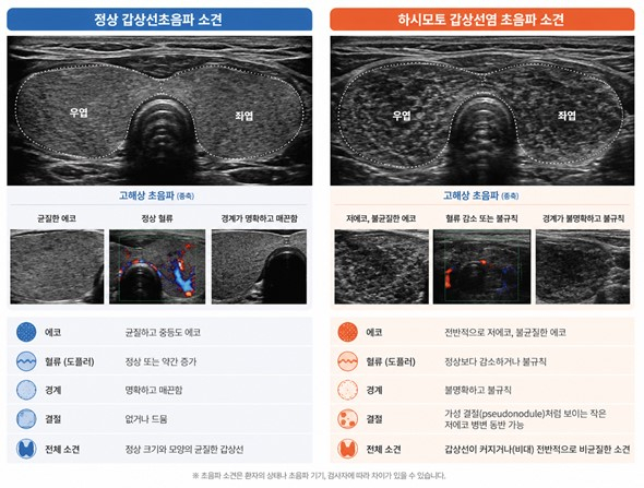 정상 및 하시모토 갑상선염의 초음파 소견. /사진제공=화순전남대병원