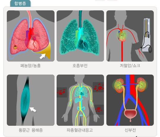 레지오넬라 폐렴 환자에게 뒤따를 수 있는 합병증. /자료=국가건강정보포털 