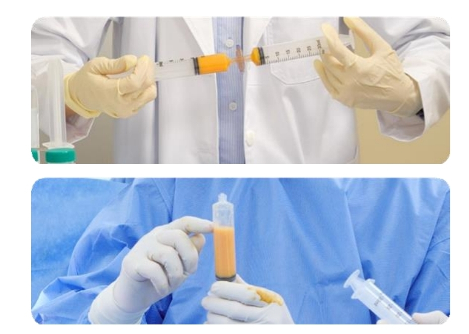 환자에게 뽑아낸 지방을 주사기를 맞댄 모양의 필터에 통과시키면 세포외기질(MAECM)만 남고, 이것이 바이오프린터에 들어가는 바이오잉크가 된다./사진=로킷헬스케어