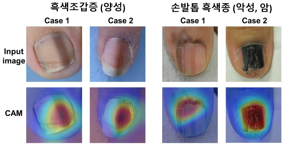 흑색조갑증(양성)보다 손발톱 흑색종(악성, 암)은 빠르게 넓어지거나 진해지는 경우가 많으며, 손톱 주변의 피부까지 퍼진다. 흑색종은 불규칙하고 다양한 색상을 나타내며, 손발톱이 갈라지거나 부서지기도 한다. AI가 두 가지를 구분하는 데 중요한 부분을 활성화(Class Activation Map, CAM)해 보여주고 있다./사진=해당 연구팀