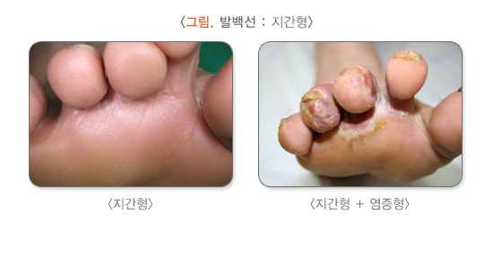 지간형 무좀(발백선) 증상 이미지. /사진=질병관리청 국가건강정보포털