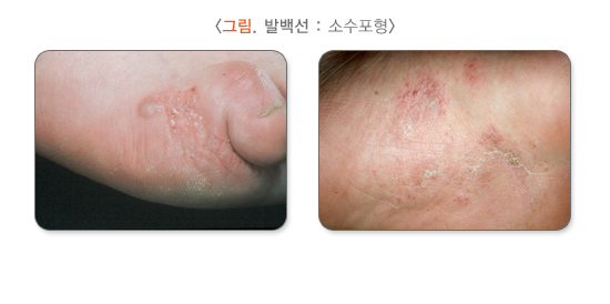 소수포형 무좀(발백선) 증상 이미지. /사진=질병관리청 국가건강정보포털