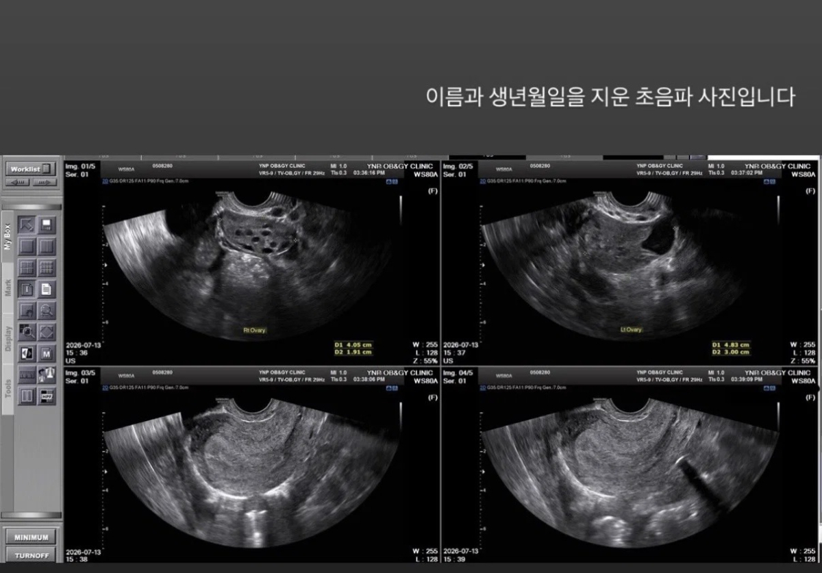 입장문이 공개된 뒤 A씨는 인스타그램에 홍민기와 나눴다고 주장하는 통화 녹취를 공개했다. 녹취에는 남성이 "제발 여기서 멈춰주면 안 되냐", "이러면 너의 화가 풀릴 것 같냐"고 말하는 내용이 남겼다. A씨가 공개한 초음파 사진. /사진=인스타그램 캡처