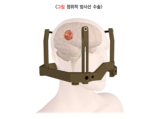 정위적 방사선 수술로 뇌종양을 치료하는 모습. /그림=국가건강정보포털