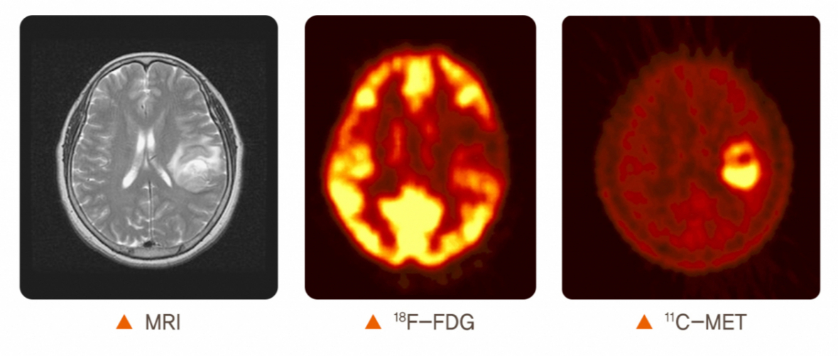 뇌종양은 MRI(자기공명영상), CT(컴퓨터단층촬영), 양성자 방출 단층촬영(PET scan) 검사 등을 통해 찾아낼 수 있다. /사진=국가건강정보포털
