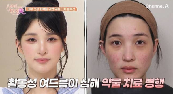 그룹 라붐 출신 율희(28)가 잘못된 생활습관과 스트레스로 망가진 피부 상태를 공개했다. /사진=채널A '뷰티 클리닉 터치미'