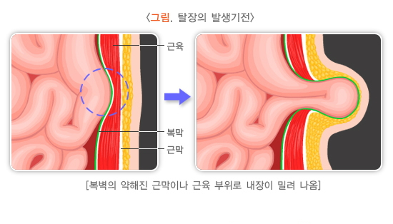 탈장 발생기전. /사진=질병관리청