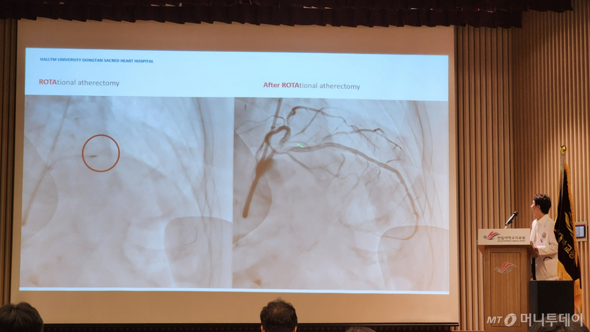 3일 경기도 화성시 동탄구에서 열린 한림대동탄성심병원 미디어데이 행사에서 이곳 순환기내과 최재혁 교수가 환자의 혈관 개통 전후 모습을 비교해 설명하고 있다. 당초 이날 발표는 한성우 병원장이 할 참이었지만, 심근경색 환자가 실려오면서 연자가 급하게 바뀌었다. /사진=정심교 기자