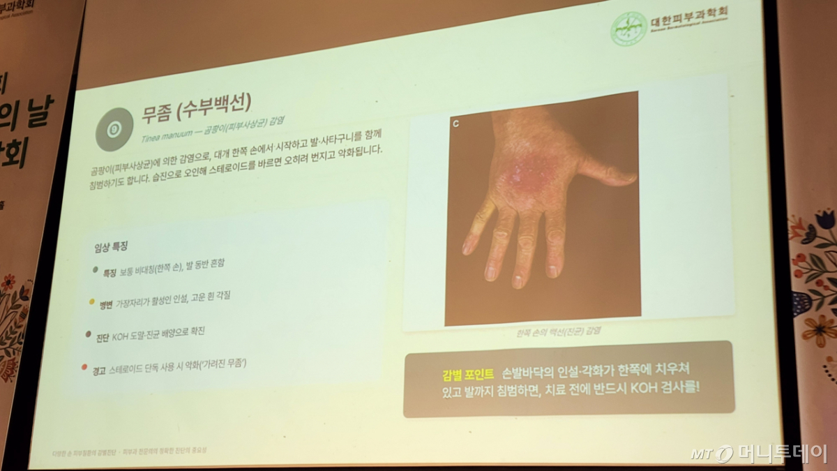 손에 생긴 무좀을 비피부과 전문의가 습진으로 오진해 병변이 커진 사례가 이날 공개됐다. /사진=정심교 기자
