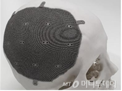 3D프린터로 제작한 티탸늄합금소재 인공두개골. /사진=NIPA