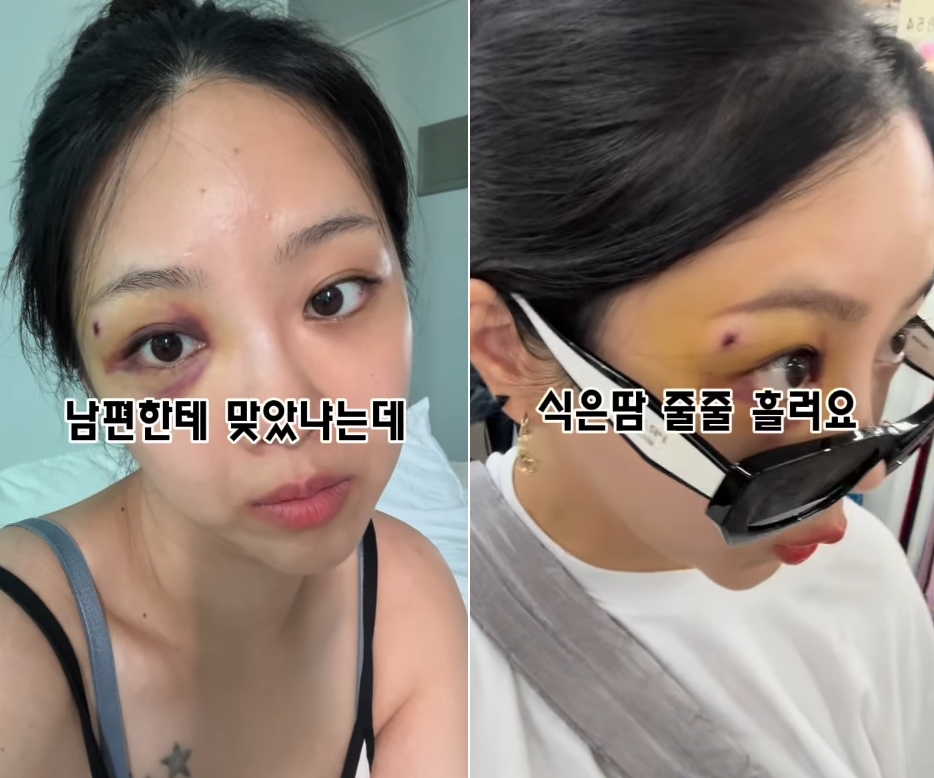 '나는 솔로' 출신 김슬기가 '돌싱글즈' 출신 유현철과 재혼 후 결혼식을 앞두고 있는 가운데 멍이 든 얼굴을 공개해 걱정을 사자 이를 해명했다. /사진=김슬기 인스타그램
