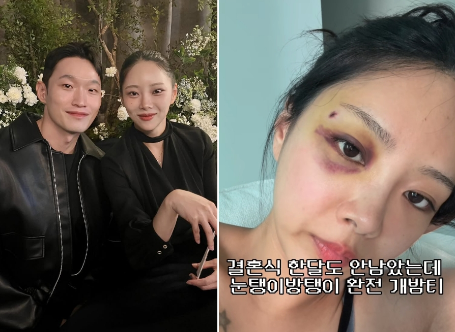 '나는 솔로' 출신 김슬기가 '돌싱글즈' 출신 유현철과 재혼 후 결혼식을 앞두고 있는 가운데 멍이 든 얼굴을 공개해 걱정을 샀다. /사진=김슬기 인스타그램