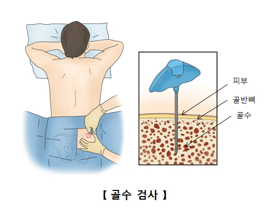 다발골수종을 진단하기 위한 골수 천자 검사법. /자료=서울아산병원