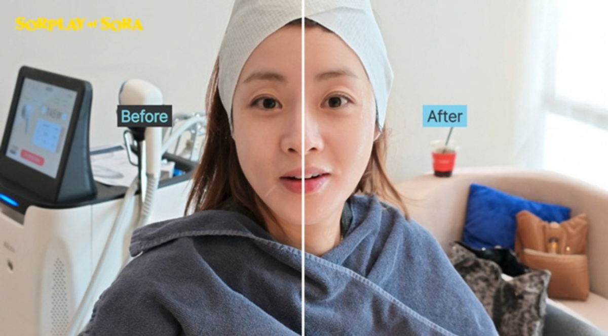 배우 강소라가 '피부 레이저 시술'을 받은 뒤 달라진 모습을 공개했다./사진=유튜브 채널 소라의 솔플레이 화면 갈무리.