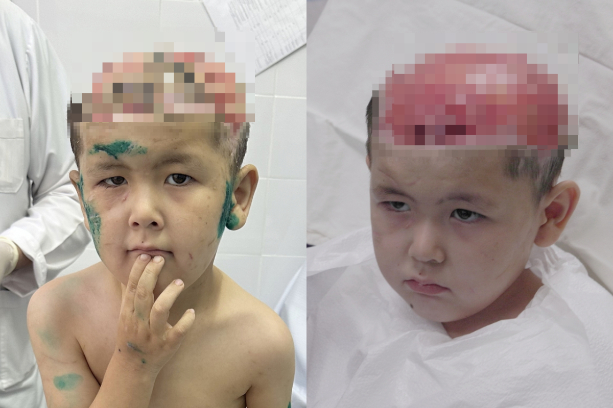 대형견 3마리에 공격당해 두개골이 드러날 정도로 두피가 손상된 키르기스스탄 아이 우마르(남·6). 의료기술 전수를 위해 키르기스스탄을 방문한 서울아산병원 의료진을 기적적으로 만나 한국에서 재건술을 성공적으로 받았다. 지난 4월 사고 직후 키르기스스탄 국립소아병원에 입원한 우마르의 모습(왼쪽)과 지난 7월 한국에 도착해 서울아산병원에서 첫 진료를 보고있는 우마르의 모습(오른쪽). /사진=서울아산병원