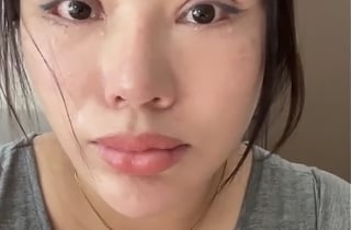 "평생 눈 못 감아" 쌍꺼풀 수술 부작용 폭로...중국 병원 실체 '충격'