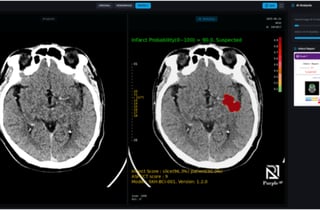 AI 보조로 뇌경색 진단 정확도 3.6%↑…퍼플AI, 연구논문 게재