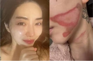 [단독]권민아도 화상 입었는데, 리프팅 부작용 피해구제 연 14건뿐…"제도 공백"