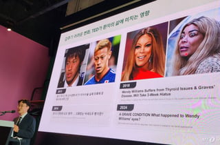 "왜 눈을 그렇게 떠?" 오해 받던 이 병...실명 위기? 드디어 치료제 도입