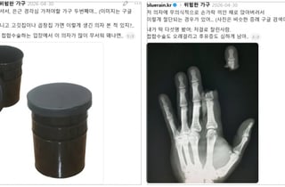 드럼통 의자에 손가락 절단…"얼음물에 바로 담갔다간 큰일"[한 장으로 보는 건강]