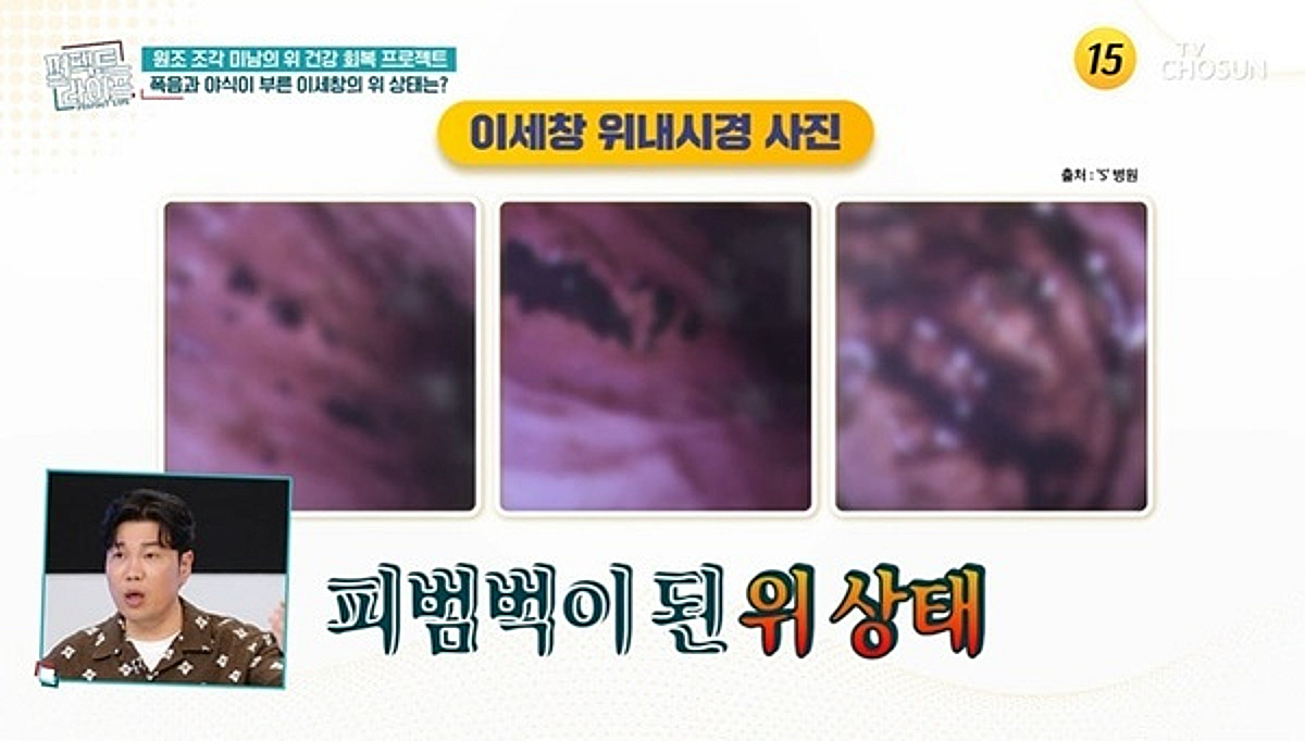 이세창, 위내시경 사진 공개 소주 2병으로 줄여