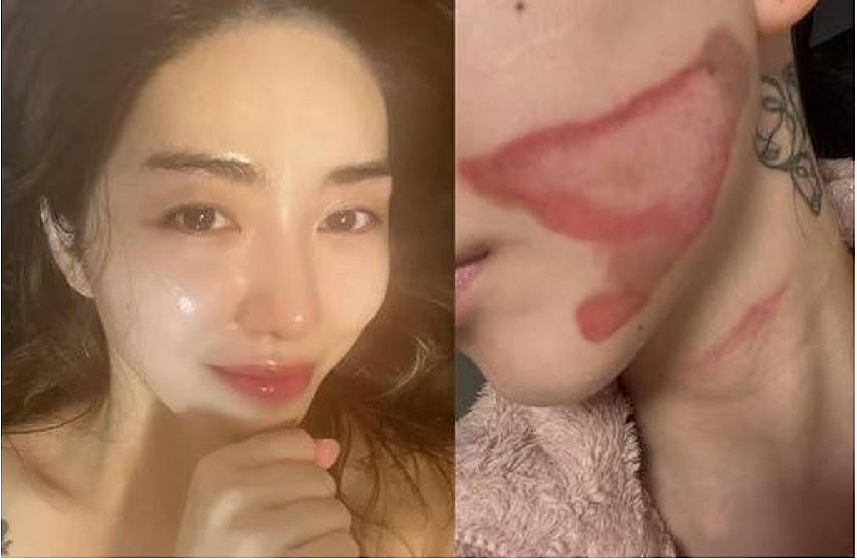 [단독]권민아도 화상 입었는데, 리프팅 부작용 피해구제 연 14건뿐…