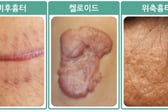 "여드름인 줄 알았는데" 가슴·턱에 '팥알'처럼 볼록…흉터 정체는?