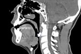 혓바닥 감염시킨 HPV, 매년 5000명 암 진단받는 이유 [한 장으로 보는 건강]