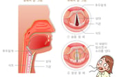 "목소리 안 나와" 목구멍 들여다보니 '이것' 자라…"2주 넘기지 말아야"