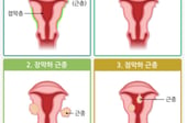 "생리통이겠지" 넘겼는데 날벼락..."아기 낳기 힘들다" 이 병 급증