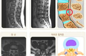 뒤로 젖혔다가 "아악"… 허리디스크로 착각 쉬운 '꼬부랑 할머니병'
