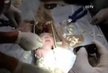 변기에 버려진 아기, 하수관 잘라내 '기적적 구출'