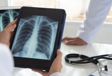 폐암 4기, 수술·방사선 '적극적 치료'했더니 58%가 '2년 생존'