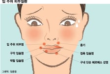 "마스크 벗었더니 입 주변 난리"…여드름이 아니었네
