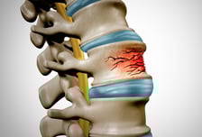 허리 아프면 골다공증 치료 결과 절반 뚝↓…효과적인 약물도 달라