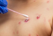 아이 온몸에 물집이…마스크 내리니 수두·볼거리 20%대 급증