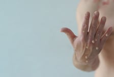 엠폭스 국내 확진자 15명 추가 발생, 누적 75명… 백신 접종 932명