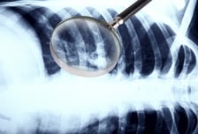 '암 생존자' 어느새 228만명…"남은 삶 위해 '뼈 건강' 조기 관리를"