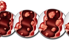 젊은 환자 '대장암' 더 독했다…생존율 높은 비결은 나이 아닌 이것