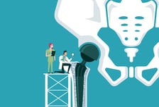 고관절 인공관절 수술, 젊을 때 해도 10년 이상 '거뜬' 세계 첫 보고