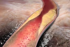 "대변으로 콜레스테롤 내보내"… 간(刊) 유전자서 배출 기전 찾았다