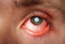 또 눈곱이 덕지덕지…휴가철 불청객 찾아왔다