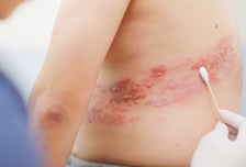 땀이 줄줄, 에어컨 '빵빵' 틀었다가…대상포진 '날벼락'