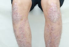 '벅벅' 긁다 또 피범벅…우울감 부르는 '하얀 비늘' 건선 막으려면