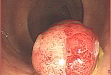 대장 내시경은 5년에 한 번?…"이럴 땐 내년에 또 받아야"