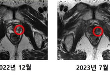 한달만에 암 사라져, 주변 장기 피해 '0'…3000억 들인 '꿈의 치료기' 성공